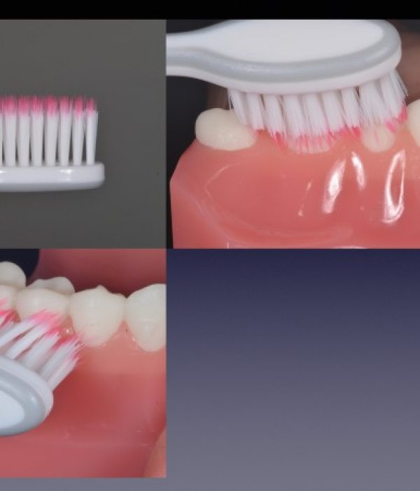 brossage de dents avec brosse adaptée